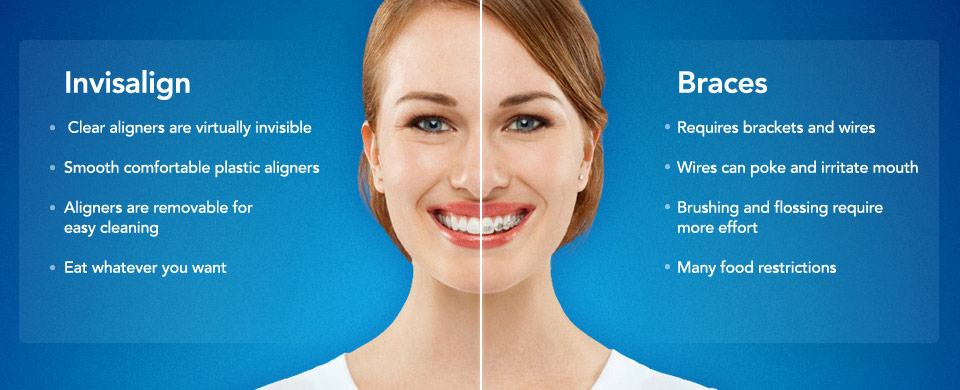 Invisalign in Langley, Bc