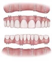 Teeth in A Day in Langley, BC