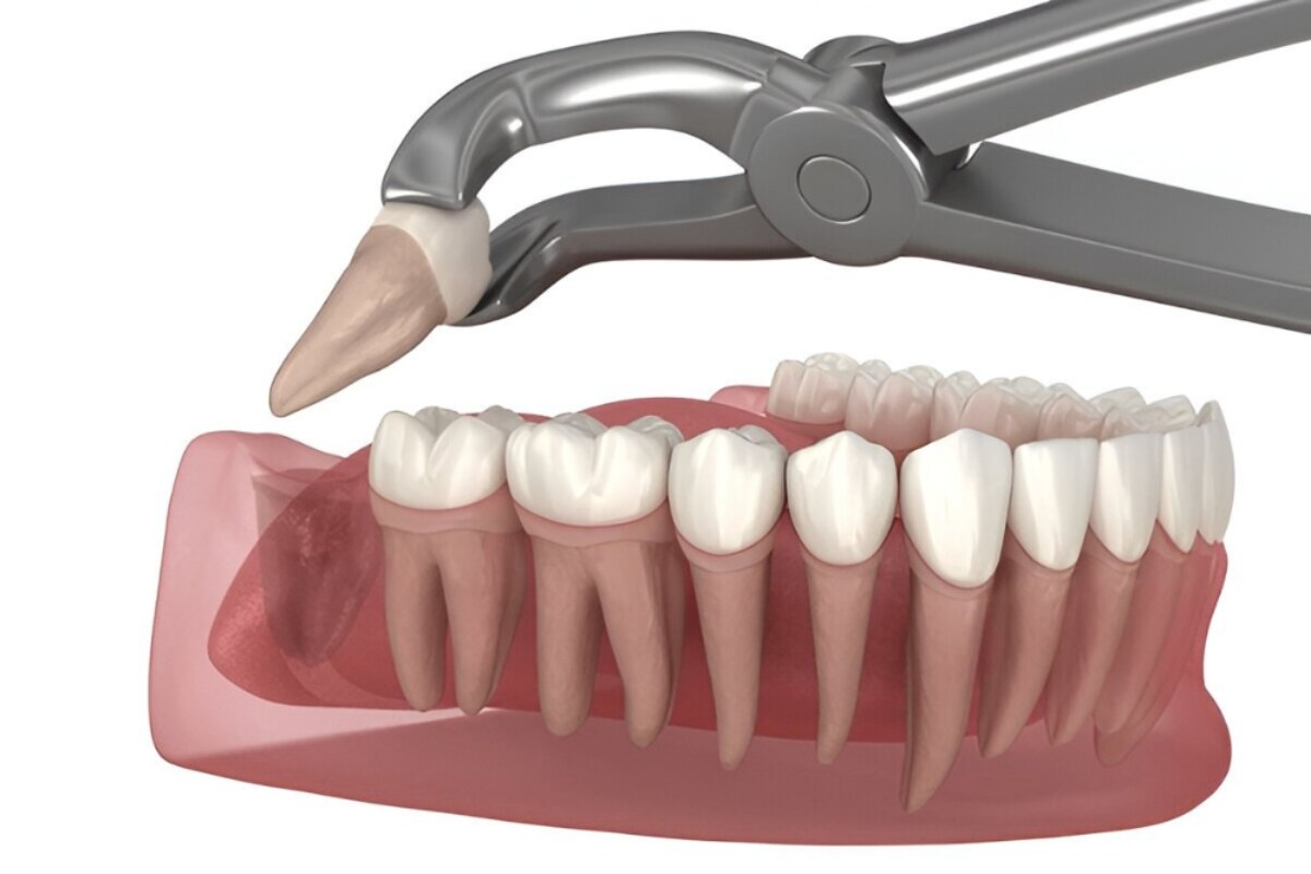 5 Signs You May Need Wisdom Tooth Extraction