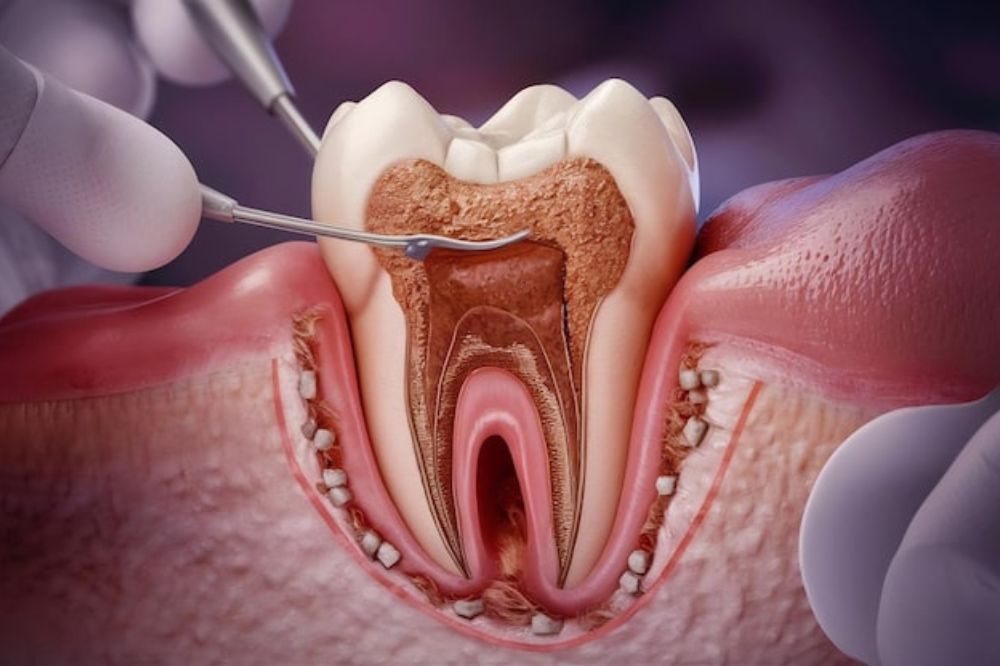 Root Canal Treatment for Elderly Patients: Special Considerations and Care