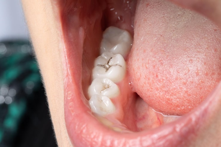 composite fillings in langley