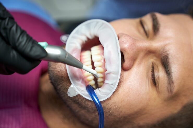 dental bonding in Langley