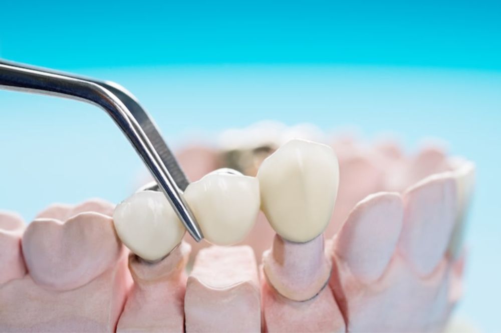 Dental Bridges in Dentistry: Types, Process, and Long-Term Benefits