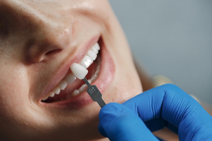 dental veneers in langley