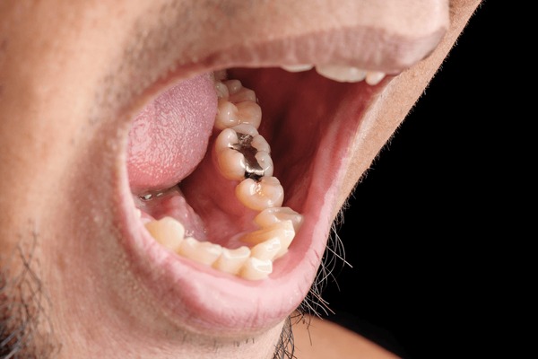 mercury-free fillings near you