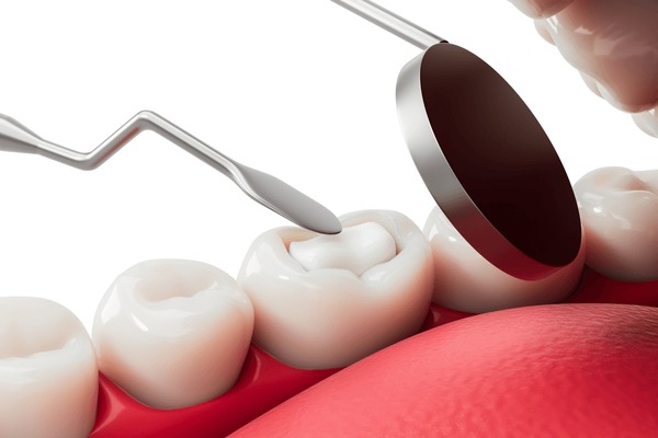 white fillings in langley
